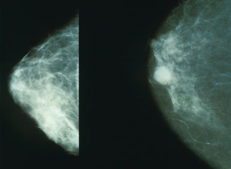 Mammogram from Wikipedia. The breast on the left is healthy, the one on the right is cancerous